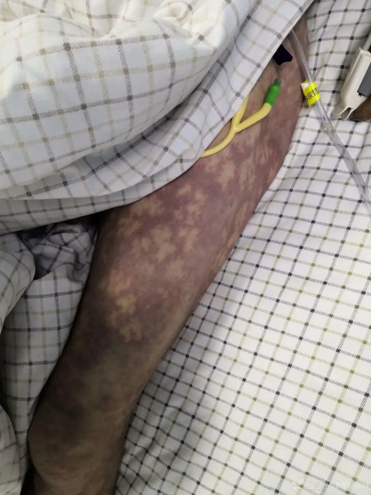 突发腰腹疼痛,周身紫色花斑,入院半小时后抢救无效死亡_腾讯新闻