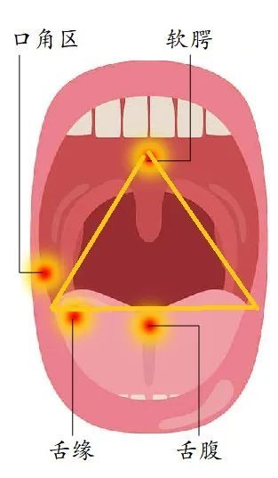 发病位置固定,常位于口腔内的"危险三角区",即舌缘舌腹,口角区内侧
