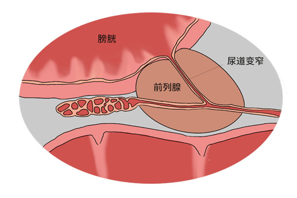 30歲的男性請注意前列腺炎可能盯上你2種前兆趁早發現