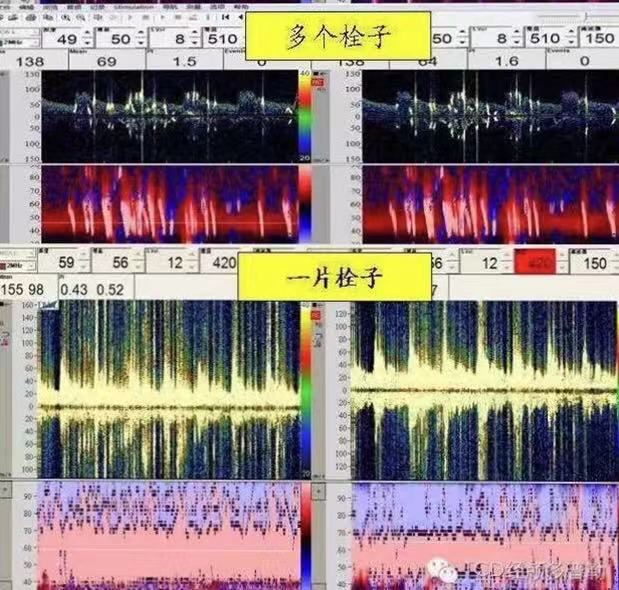 医讯】神经电生理检查室又添"利器"——经颅多普勒超声血流分析仪tcd