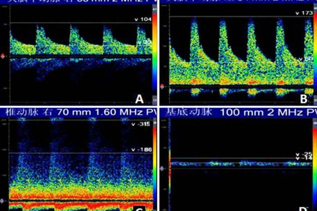 医讯神经电生理检查室又添利器经颅多普勒超声血流分析仪tcd