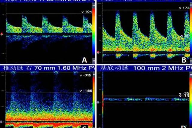 颅内多普勒血流图(tcd)图片