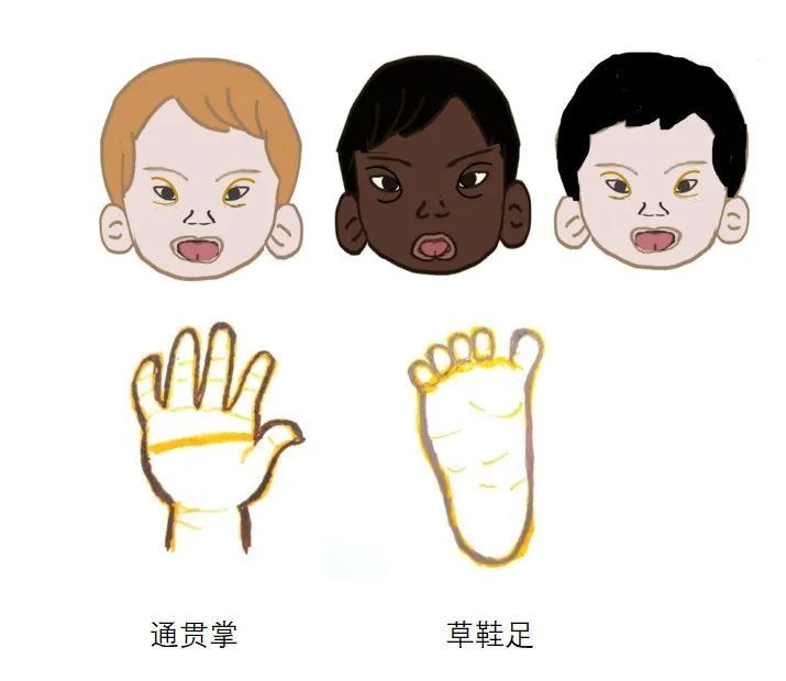 唐氏儿通常表现为眼角上斜,眼距宽,鼻梁低平,张口吐舌;通贯掌;草鞋足