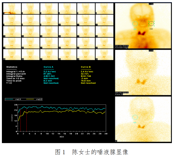 核医学唾液腺显像图片