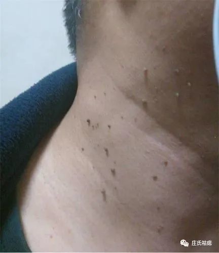 脖子上的这些小瘊子可怕吗?