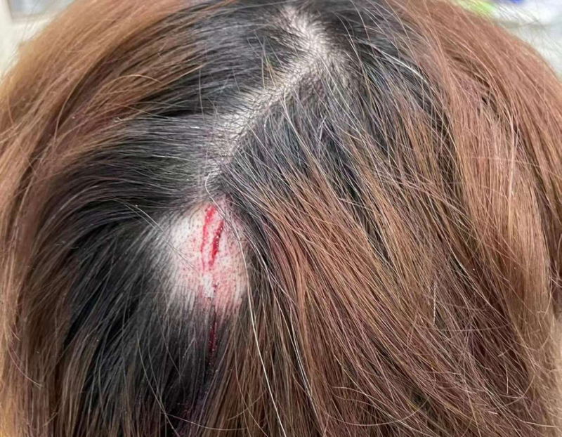 天降铁钉扎伤居民后脑勺责任谁担难认定