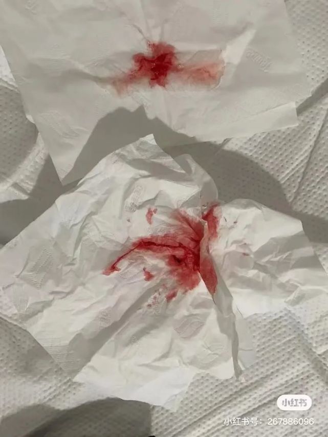 昨天晚上,再次被抢救 上了呼吸机,咳到了吐血,肿瘤依旧在继续变大并