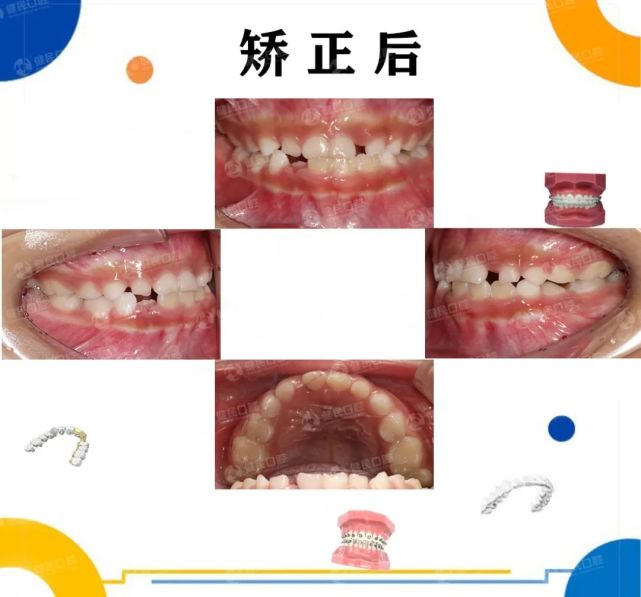 【儿童矫正合集分享】9岁地包天的小男孩eta儿童早期矫正,矫正不用等