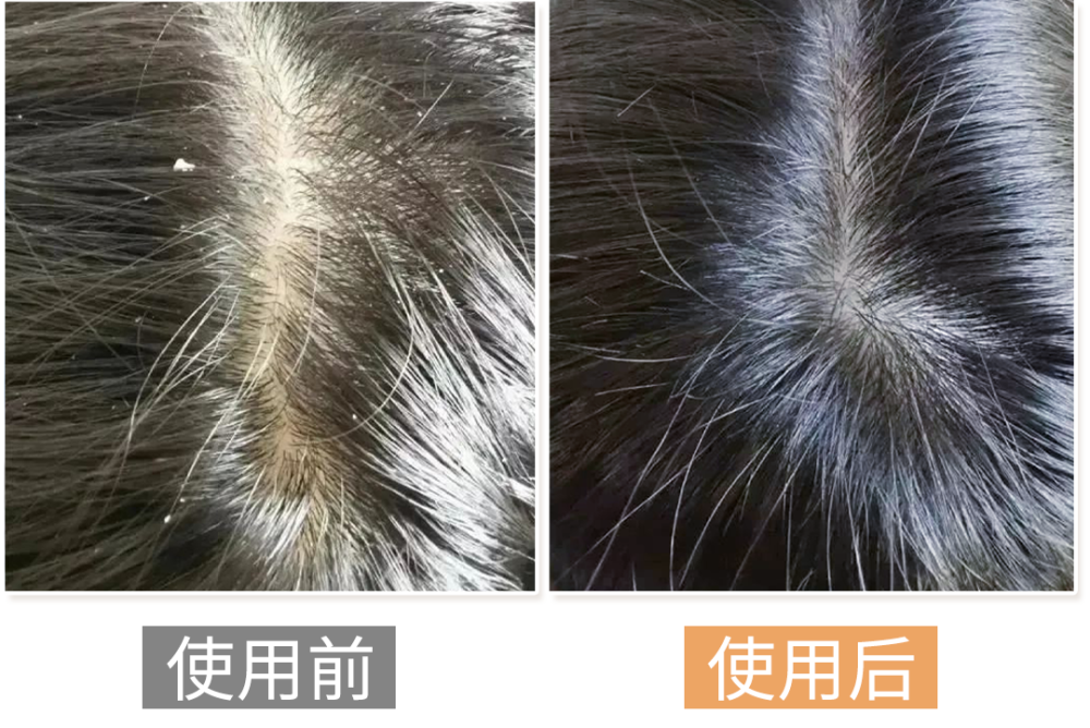 头皮油脂"清道夫"!清爽出门,不再油头_腾讯新闻