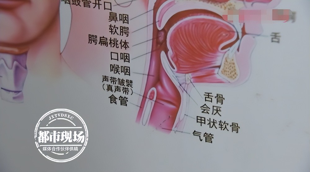 8旬老人吞下铂金戒指卡住喉咙难受至极医生1秒化解危险