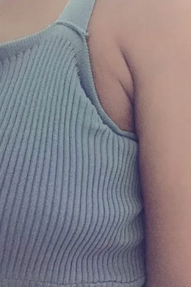 副乳,不是胖出来的!