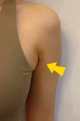 副乳,不是胖出来的!