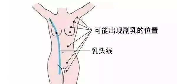 副乳,不是胖出来的!