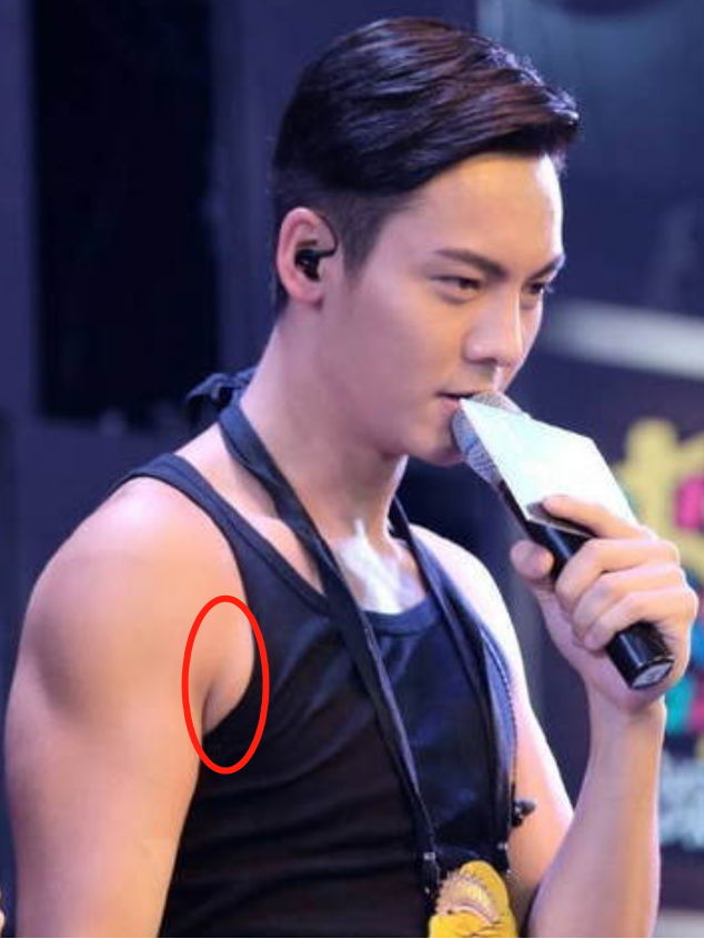 副乳,不是胖出来的!