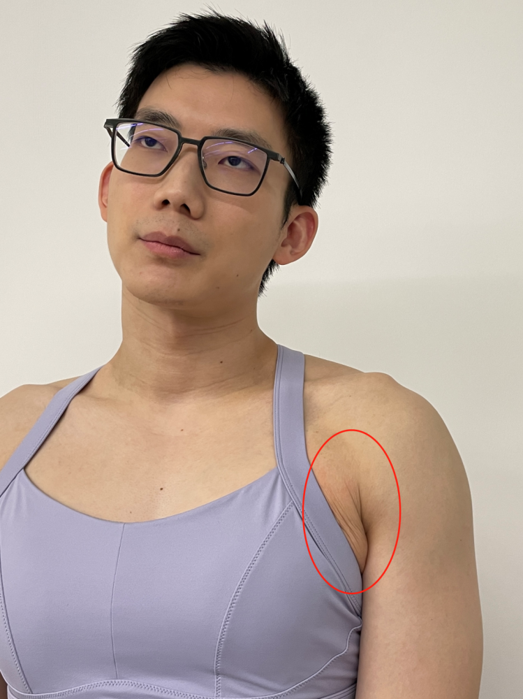 副乳,不是胖出来的!