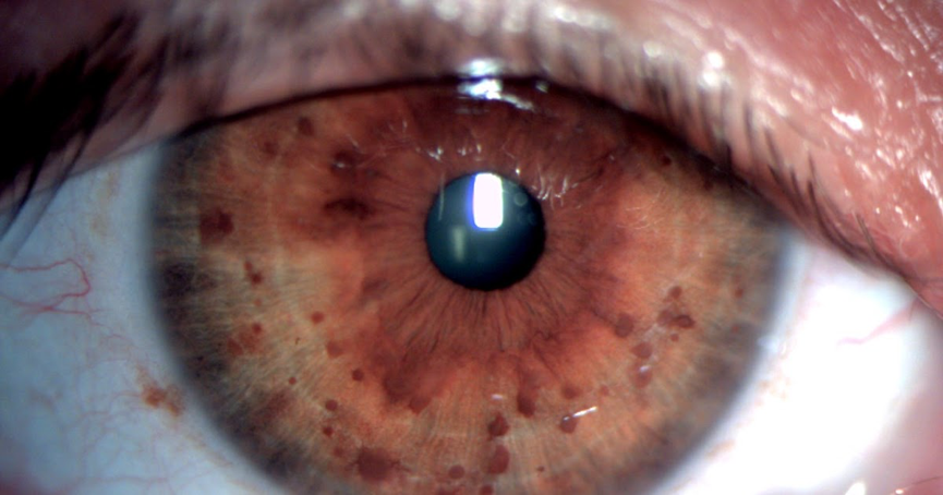 身上的咖啡斑不是皮肤病超过2个神经瘤不是巧合神经纤维瘤病