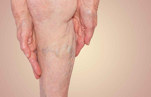 而且下肢血管会变得比较粗且突出,形成下肢静脉曲张现象.