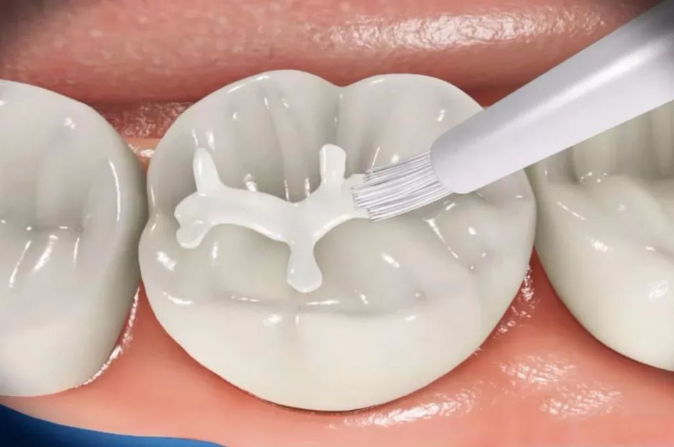 孩子牙齿涂氟为何那么流行窝沟封闭要做吗有无副作用