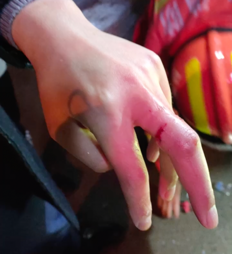 尖嘴钳等破拆工具现场消防员立刻使用手指末端已出现充血肿胀因长时间