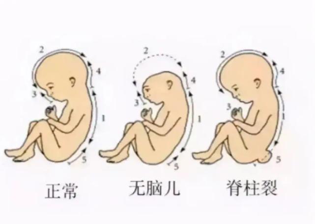 出現唇裂,顎裂甚至無腦兒,無脊髓等嚴重畸形