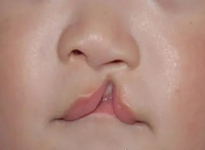 如果胎儿神经管畸形,在出生后神经管部位就可能存在缺陷,出现唇裂