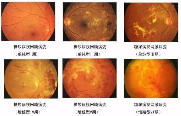 Ⅵ(增生晚期)Ⅴ(纤维增生期)Ⅳ(增生早期)增生型糖尿病视网膜病变Ⅲ