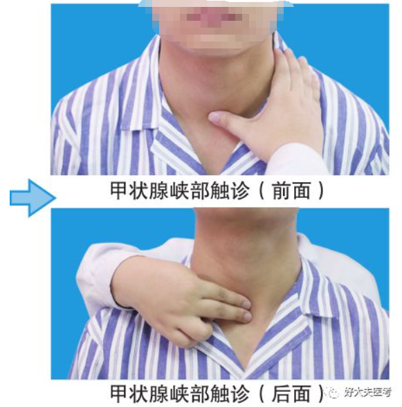甲状腺峡部触诊:检查者站于被检查者前面,用拇指(或站于受检者后面用