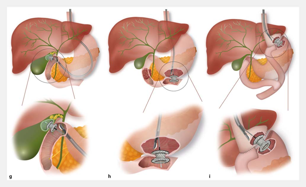 of the pancreaticobiliary and gastrointestinal tract showing: g