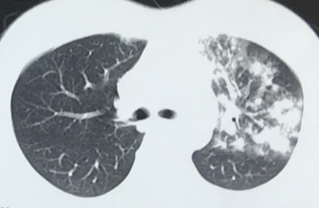 肺结核如何诊断？从胸部 CT 到实验室检查，这篇文章讲清楚了｜世界防治结核病日_腾讯新闻