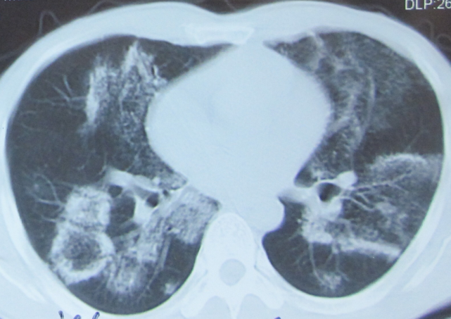 從胸部 ct 到實驗室檢查,一文講清|世界防治結核病日