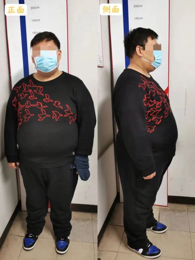 减重案例脖子越洗越黑原来是黑棘皮症