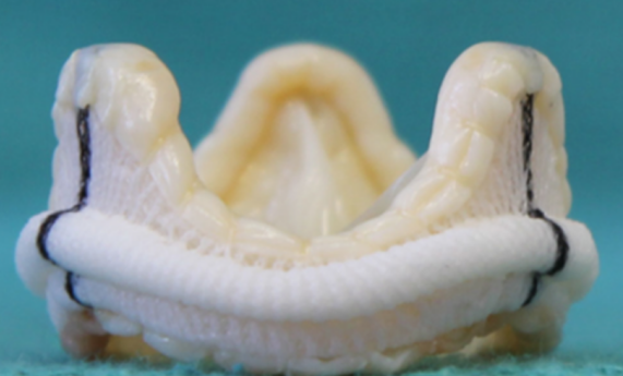 瓣重度狭窄合并冠心病"在我院进行了"主动脉瓣生物瓣置换 冠脉搭桥术"