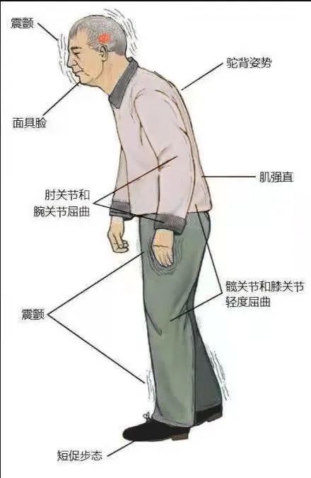 运动症状包括静止性震颤,运动迟缓,肌强直和姿势平衡障碍,非运动症状