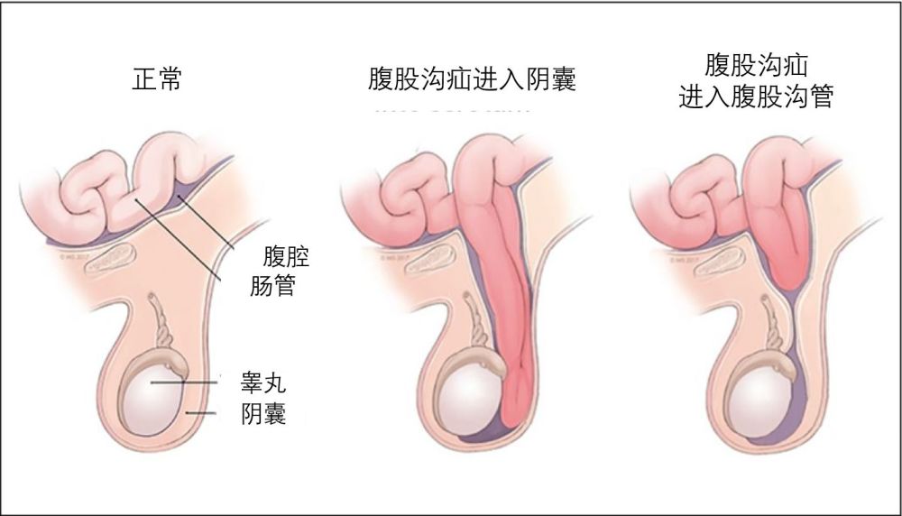的情况,会导致肠子,卵巢或者大网膜等沿着缺口跑到腹股沟或者阴囊里