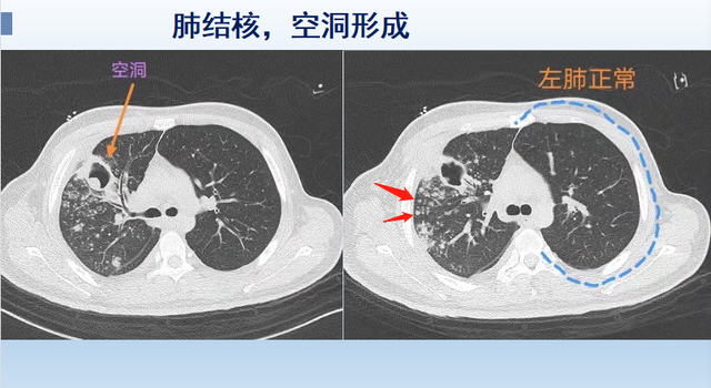 就是咳嗽,胸疼,有时候平躺的时候呼吸困难,但ct发现典型肺结核(图1-2)