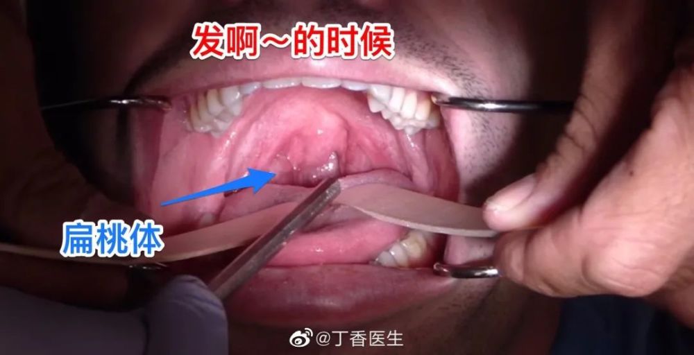 正常喉咙小舌头图片图片