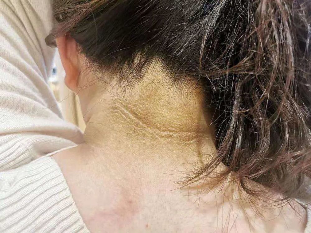肥胖和糖尿病引起的黑棘皮病不会给身体带来严重的危害,主要是因为