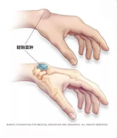 手背上凸起的肿块被我捏瘪了医生我还有救吗