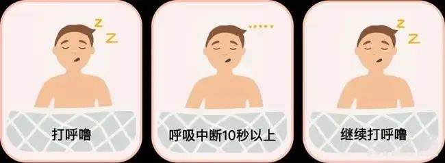 打呼噜不一定是睡得香 谨防睡眠呼吸暂停综合征找上门