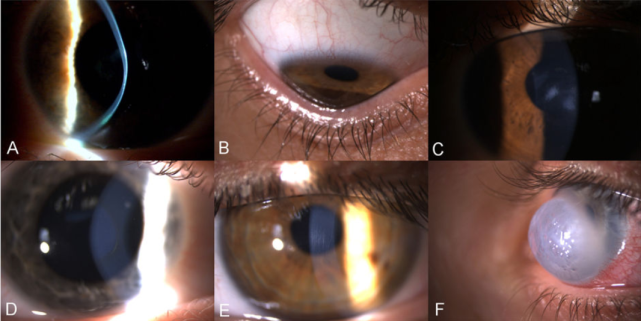 圆锥角膜病患福音!上海这项新研究有望提供更安全有效的策略_腾讯新闻