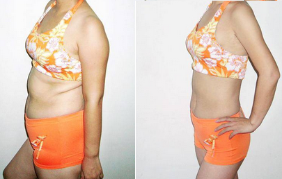 手術(shù)減肥_減肥手術(shù)切胃_減肥手術(shù)有哪些方法