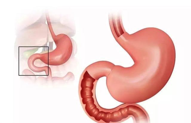 手術(shù)減肥_減肥手術(shù)有哪些方法_減肥手術(shù)切胃