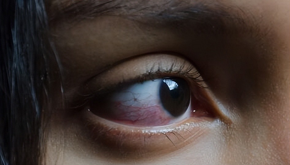 有这么严重,只不过是"红眼了",当时出产房的时候,白眼球都变成了红色