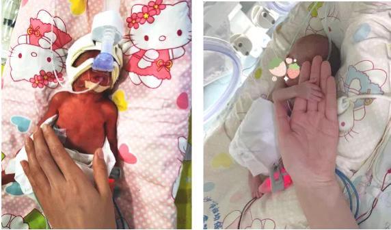 出生仅680克一超低体重早产儿从长沙市妇幼保健院顺利出院