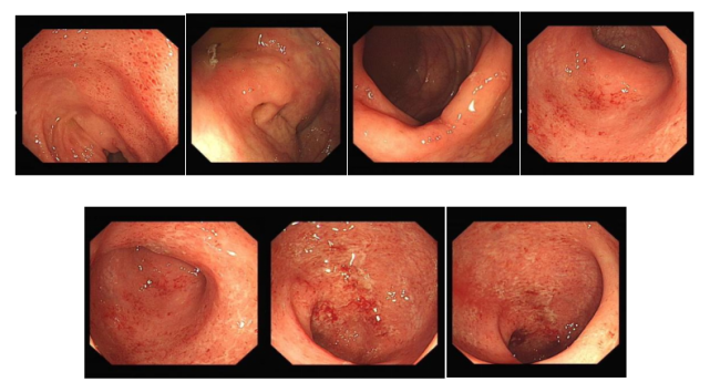 散在糜爛,升結腸見散在糜爛,距肛緣約15cm以下直腸見黏膜瀰漫性充血