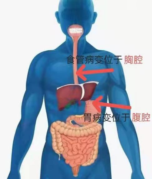 近日外一科團隊收治一例胃癌(腫瘤位於賁門)合併食管中段早癌的雙源