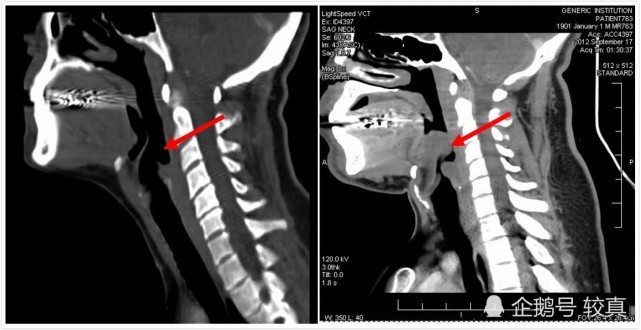 右侧是急性会厌炎的人的喉头.区别一目了然.