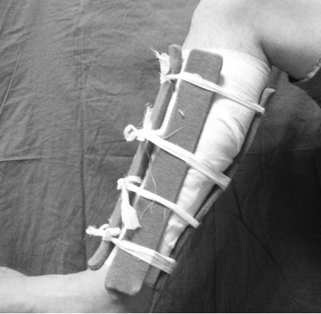 (2)一次包扎法:骨折复位后先包内衬绷带,然后将几块小夹板一次安置于