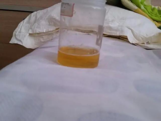 深黄色尿液——正常尿液颜色为淡黄色,如果尿液颜色过深,甚至达到棕