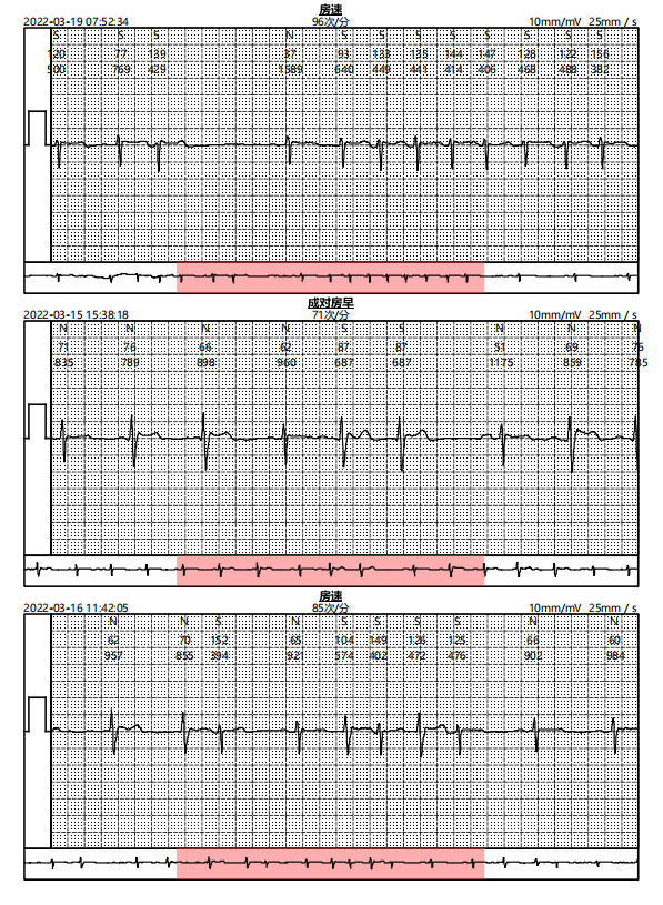 常規心電圖顯示房早室早患者心律失常篩查